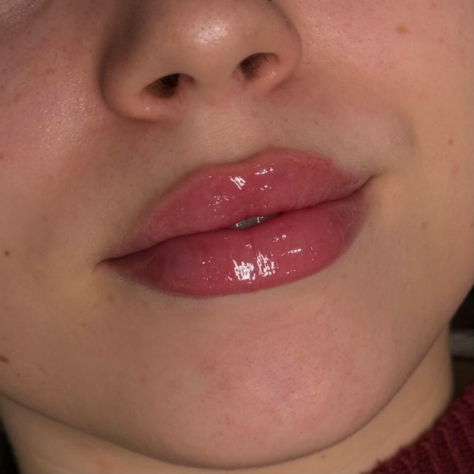 Soft volume and definition after Russian lip enhancement