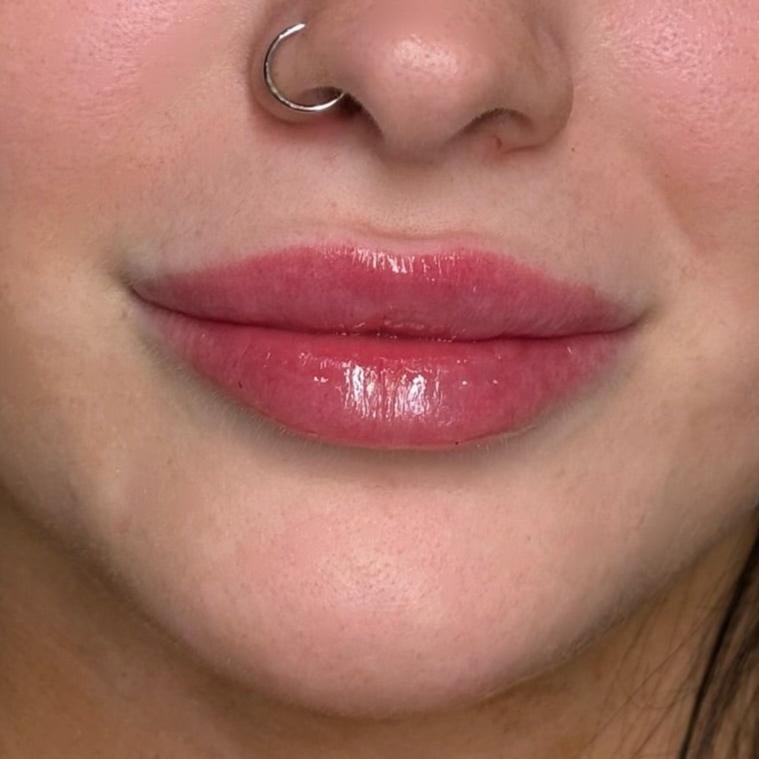 Natural-looking Russian lip enhancement after treatment