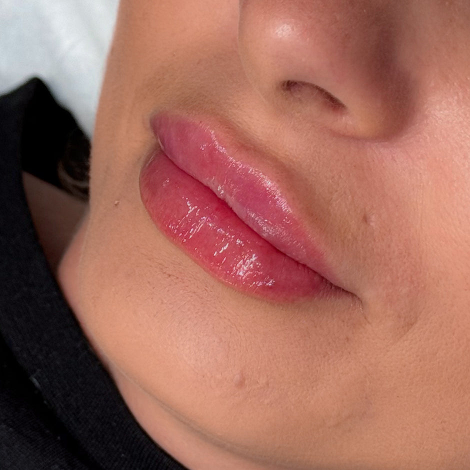 Close-up of lips after Russian lip filler procedure
