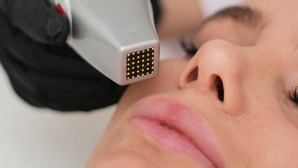 Woman receiving a cosmetic treatment on her face with a device.